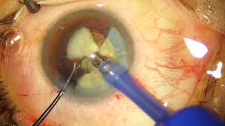 White Cataract - Direct Chop using Oertli Catarhex Machine