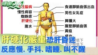 肝硬化嚴重恐肝昏迷 反應慢.手抖.嗜睡.叫不醒 健康2.0