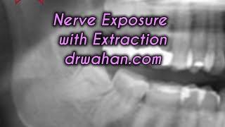 Nerve Exposure with Wisdom Tooth Extraction: With tips on predicting it and managing paresthesia