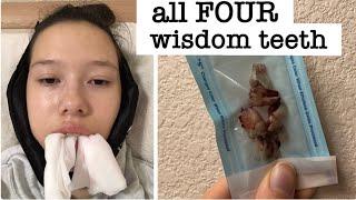 4 Wisdom Teeth Removed in 1 Day - My Recovery!