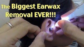 The Biggest Ear wax Removal EVER!!!