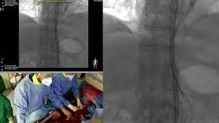 e-nside implant with total retrograde femoral approach