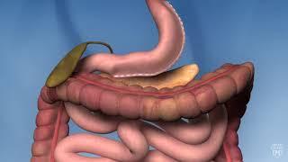 Sleeve Gastrectomy