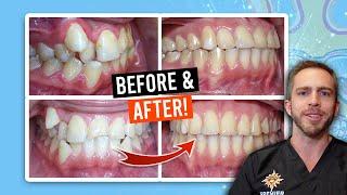 BRACES for MODERATE CROWDING! [BEFORE & AFTER]