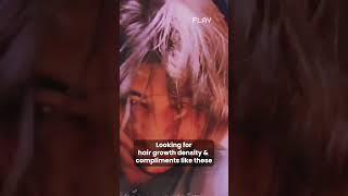 Male Pattern Baldness, Stop Hairloss Early to Save Follicles I DR SURUCHI PURI I