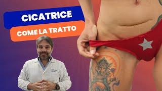 Cicatrice da PARTO CESAREO? SCOPRI il TRATTAMENTO per una Guarigione Perfetta!