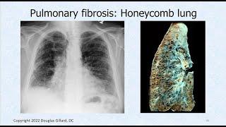 Interstitial Fibrosis & All About Pathological Auscultatory Breath Sounds: Adventitious Sounds.