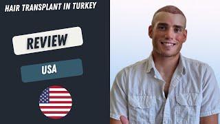 Hair Transplant in Turkey Review l Worbimed Clinic