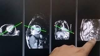 Cardiac MRI Planning 3D Chamber