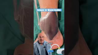 Wound Vac = Faster Healing & Lower Infection Risk #shorts