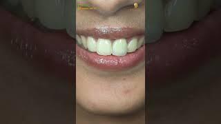 Smile Makeover: Incredible Before & After Transformation! 