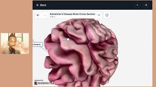 Alzheimer's Disease in Less than 6 Minutes | Brief Neurobiology Series Part 5