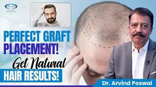 Hair Transplant में Hair Graft Placement कैसे की जाती है? Dr. Arvind Poswal, Dr. A's Clinic, Delhi