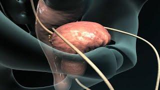 Transurethral Resection of the Prostate (TURP)