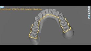 Trimming line software Orthcurve V2.1 DEMO- By Zhiyin Dental