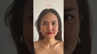 Before and After 3 types of facial contouring at Girin Plastic Surgery Korea