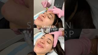 SkinPen Microneedling with PRP injections (Vampire Facial) at Wise Med Spa in Wayne, NJ!