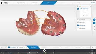 Matching scans in CEREC Primescan on an over denture case