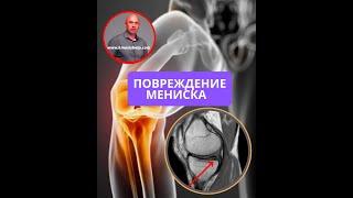 Повреждение мениска. Почему не обнаружили врачи? Что с этим делать?
