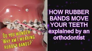 How elastics / rubber bands move teeth (time lapse) - Braces Explained!