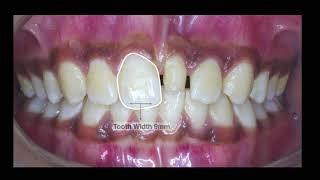 Smile Transformation -Top Dental Clinic in Guntur - Kothamas Dental Care