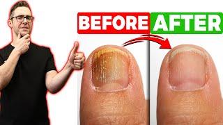 BEST Toenail Fungus Treatment 2024 [+4 BIG SECRETS]