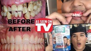 PERFECT SMILE VENEERS REVIEW As Seen on TV!