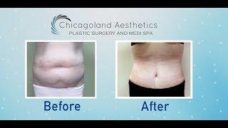 Liposuction 360 at Chicagoland Aesthetics | Plastic Surgery in Chicago