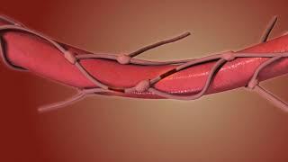 Esophagectomy. Esophagus Removal Animation