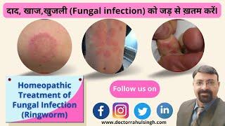 दाद-खाज खुजली का जड़ से इलाज । Homeopathic Treatment For Ringworm ।Tinea (Fungal Infection) क्या है?