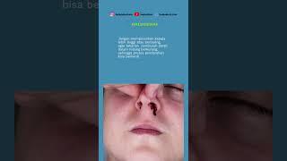 Jangan Khawatir, Ini Cara Mengatasi Mimisan dengan Benar #mimisan #caramengatasi #kesehatan #hidung
