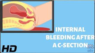 The Hidden Danger: Internal Bleeding After C-Section