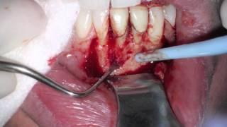 Lower Anterior Periapical Surgery