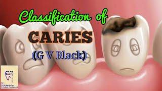 Dental Caries | Classification of dental caries | GV Black Classification