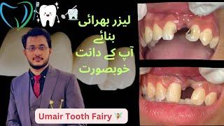 Composite filling #umairtoothfairy #dentist #umairazeem #satisfying #viral @Umairazeem8553