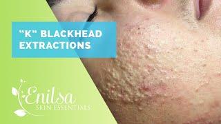 Blackheads, Whiteheads Extractions on "K" Part 1