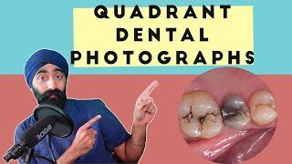 How to take Posterior Quadrant Dental Photographs