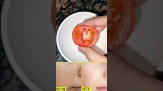 open pores home remedy #openpores #skincare #skincaretips #ytshorts #viralshorts #viral #shorts