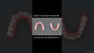 #클린체크 로 정확한 치아교정 계획을 확인해보세요 