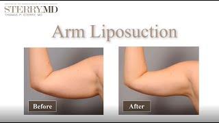 What you need to know about arm liposuction I Dr Sterry replied