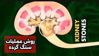 روش عملیات گرده #kidney