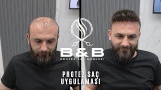 PROTEZ SAÇ UYGULAMASI -