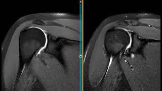 Fat suppressed T1 and Proton density images of shoulder