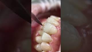 Composite restoration #dentist #shorts