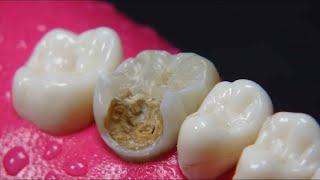 AMAZING dentist rebuilds tooth damaged by cavity: Endodontics + resin in 4K