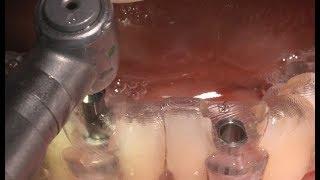 Simple & Easy immediate prosthesis using Dentium Digital Guide - Dr. Kang-Hee Lee