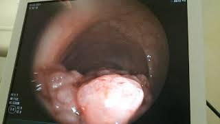 endoscopic pedonculated sigmoid polype resection