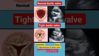 Normal and Tight Aortic valve l  l Animation #echo #shorts