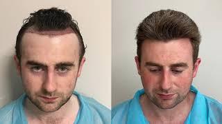 hair transplant results. FUE + FUT. 25 years experience in hair restoration. Saifi Hairtransplant