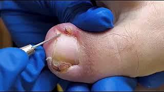 DIY Ingrown Toenail Removal | How to Safely Cut Ingrown Toenails at Home